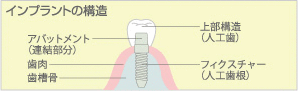 インプラントの構造